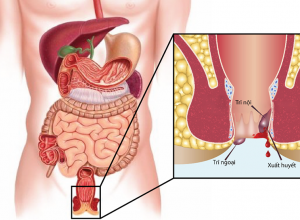 Các loại dược phẩm trị trĩ phổ biến hiện nay